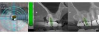 Navident EVO receives FDA Clearance for Guided Endodontics
