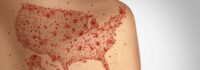 Measles Can Ravage the Immune System and Brain, Causing Long-Term Damage – A Virologist Explains