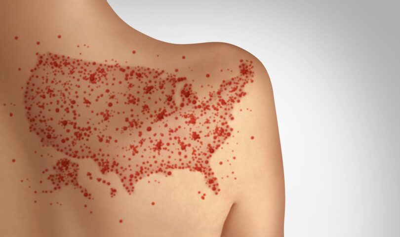 Measles Can Ravage the Immune System and Brain, Causing Long-Term Damage – A Virologist Explains
